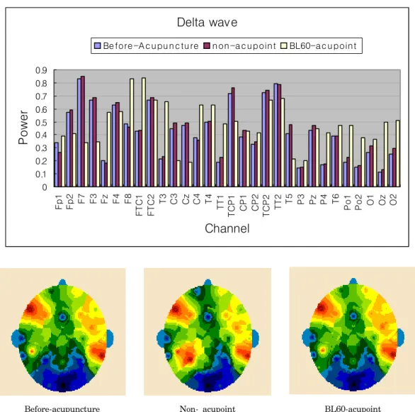 Fig.  5.  Distribution  of  delta  wave  of  the  EEG  from  30  channels  before  and  during  the  EA  treatment.