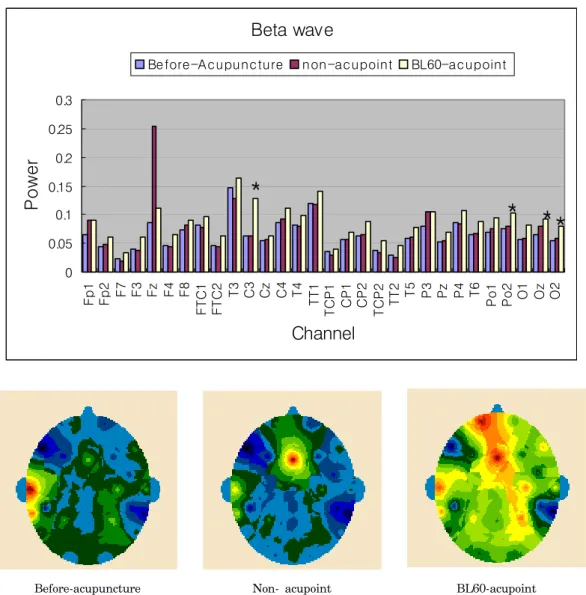 Fig.  3.  Distribution  of  beta  wave  of  the  EEG  from  30  channels  before  and  during  the  EA  treatment.