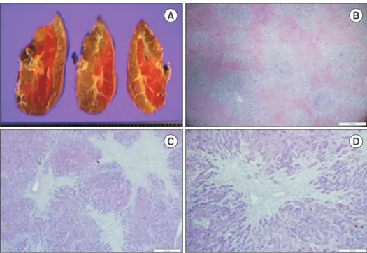 Fig. 3. Pathological finding of the explanted  liver. (A) Gross examination. The liver is  un-remarkably without mass or necrosis