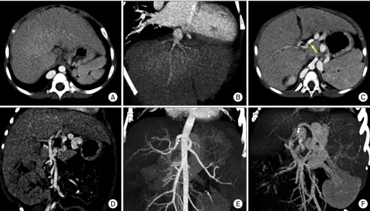 Fig. 1. Pretransplant computed tomography scan taken 1 month before transplantation. (A, B) The inferior vena cava was absent with normal develop- develop-ment of hepatic veins