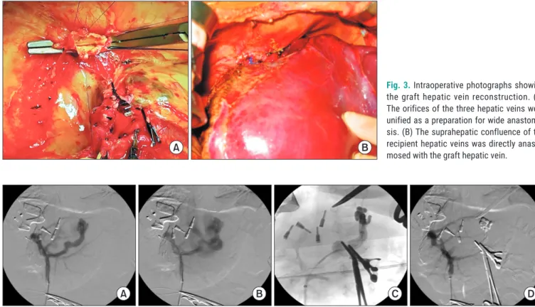 Fig. 3. Intraoperative photographs showing  the graft hepatic vein reconstruction. (A)  The orifices of the three hepatic veins were  unified as a preparation for wide  anastomo-sis