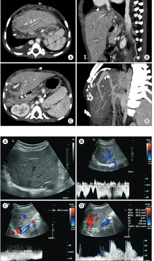 Fig. 5. Posttransplant computed tomogra- tomogra-phy scan taken 4 days after transplantation