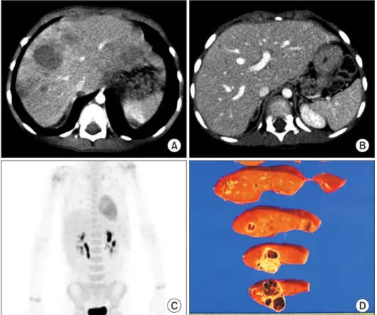 Fig. 1. Pretransplant findings of case No. 