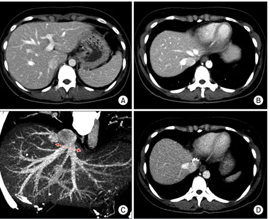 Fig. 2. Preoperative imaging studies of  the living donor of case No. 1. Computed  tomography scans show the shape of the  left liver (A) and the anatomy of the left and  middle hepatic veins (B, C)