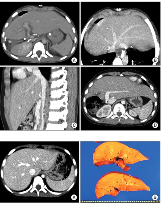 Fig. 4. Posttransplant computed tomog- tomog-raphy (CT) follow-up of case No. 1. (A) CT  scan obtained 4 days after transplantation  shows uneventful graft implantation