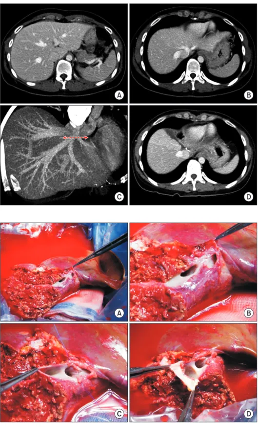 Fig. 6. Preoperative imaging studies of  the living donor of case No. 2. Computed  tomography scans show the shape of the  left liver (A) and the anatomy of the left and  middle hepatic veins (B, C)