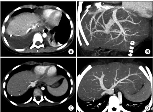 Fig. 8. Posttransplant computed tomogra- tomogra-phy (CT) follow-up of case No. 2. CT scan  obtained 12 days after transplantation  shows right pleural effusion (A) and slight  compression of the graft hepatic vein  recon-struction (B)