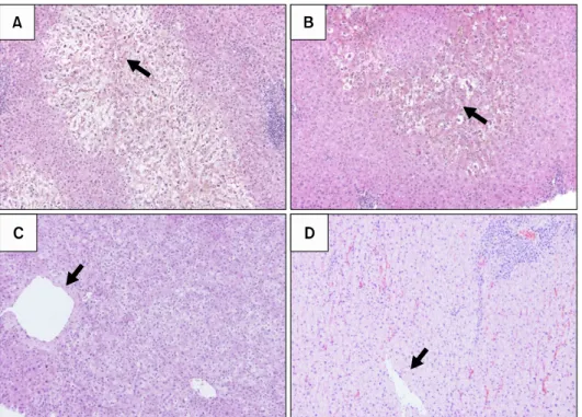Fig. 1. Severe hepatocyte ballooning with  cholestasis  around  the   peric-entral venous area (A) and the  re-covering phase (B), representing early allograft dysfunction (EAD) including small-for-size  syndrome