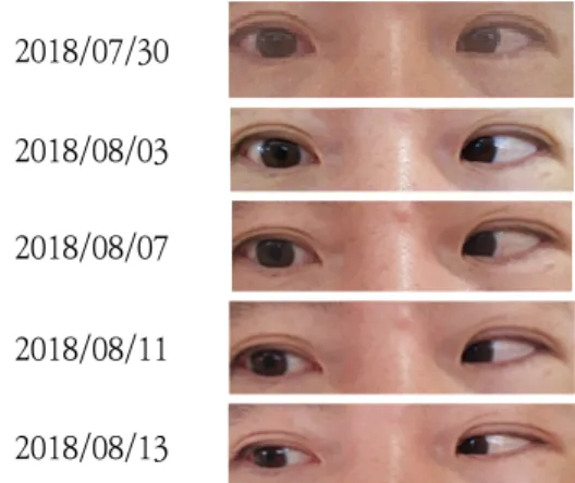 Fig.  7  Progress  Note  of  Eye  Movement. 