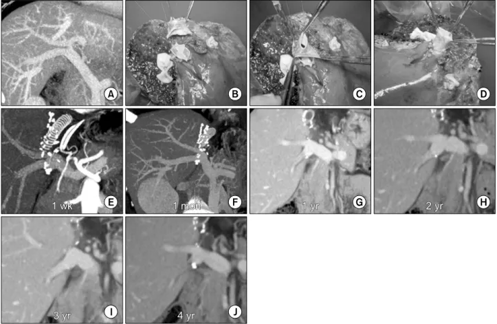 Fig. 3. Sequential changes of the recipient portal vein (PV) reconstructed by the conjoined unification venoplasty technique