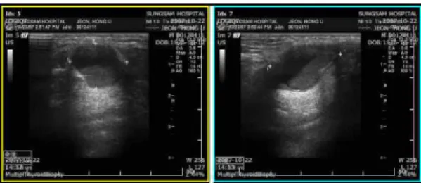 Figure  1.  THYROID  USG  2007-10-22 CONCLUSION) Thyroglossal duct cyst