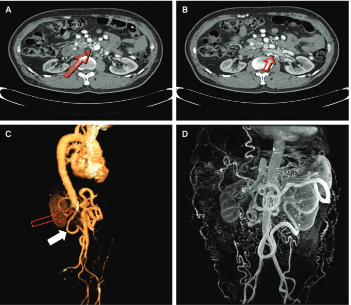 Fig. 1. Imaging of computed tomography (CT) and magnetic resonance angiography (MRA). (A) Origin of right renal artery (arrow) was not found around aorta, supplied by branch vessels arose from distal superior mesenteric artery and left renal artery