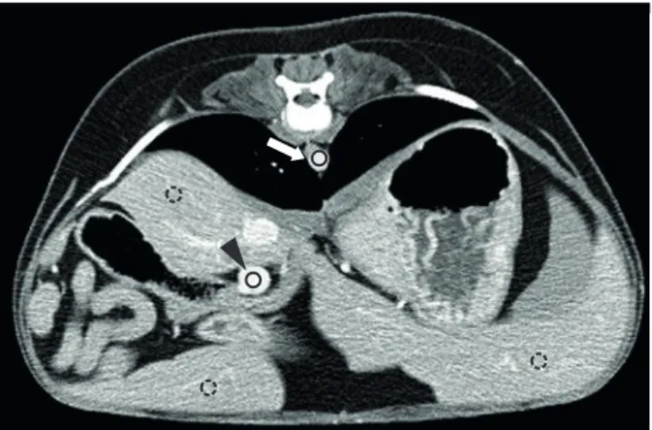 Fig. 1. Circular ROIs are placed at the level of the aorta (arrow), portal vein (arrowhead), and liver parenchyma  (dotted lines)