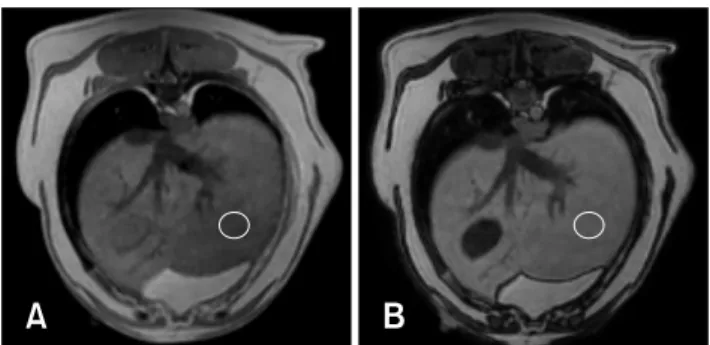 Fig. 1. Representative example of the appearance of a normal  liver in the in-phase (A) and opposed-phase (B) imaging from  dual gradient echo magnetic resonance imaging sequences
