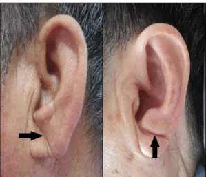 Fig. 2. Earlobe wrinkles due to aging which could  be shown in the normal group.