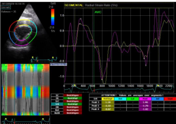 Fig. 2. Radial strain in the interventricular septum (purple) and 