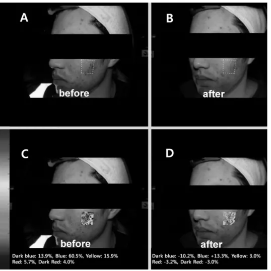 Table  4.  Changes  in  Proportion  of  Facial  Inflammatory  Lesion  Measured  by  Dermavision-pro ® (Multimodal  facial  color  imaging  modality)