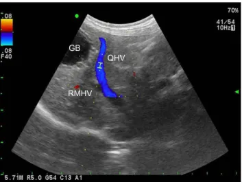 Fig. 3. Three types of hepatic venous flow patterns in dogs with tricuspid regurgitation (TR)