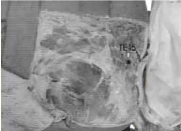 Fig. 5. Photograph shows triple energizer mer- mer-idianpoints(TE 10-TE 13) at body  sur-face of arm.
