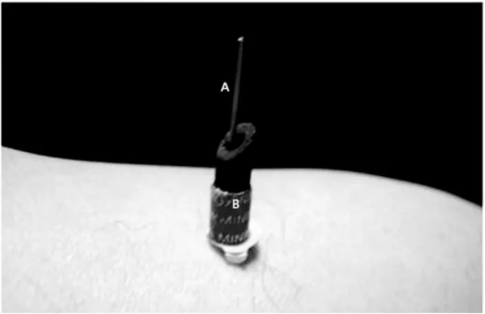 Fig.  1.  Features  of  warm  needling.
