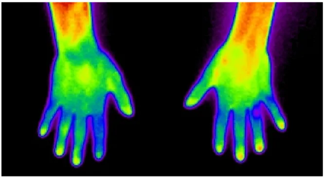 Fig.  2.  Digital  Infrared  Thermographic  Image  of  hand  after  treatment(2013-09-12).