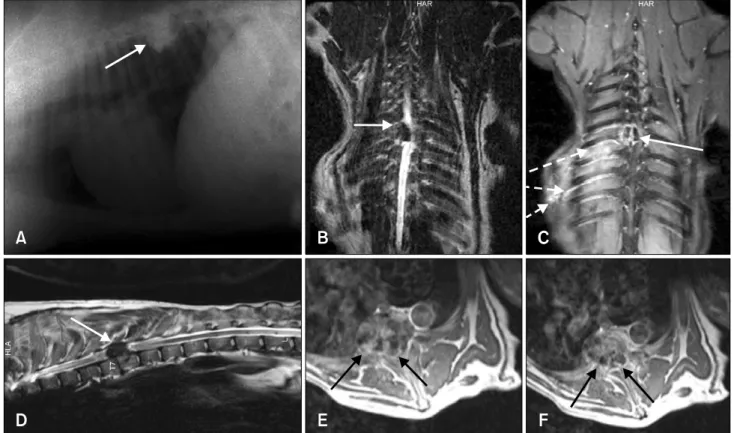 Fig. 1. Osteoma. Lateral X-ray image showing marked bony proliferation over the 8th–9th thoracic vertebrae (arrow in A)