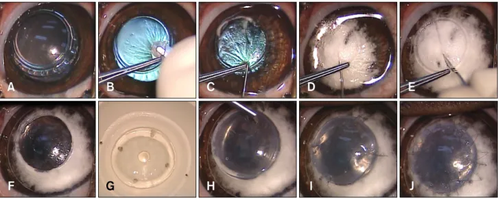 Fig. 1. Procedures for deep anterior lamellar keratoplasty using the big bubble technique