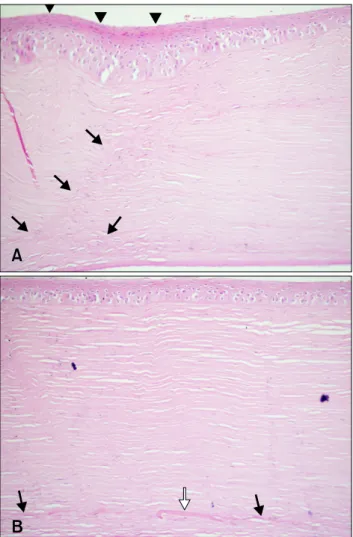Fig. 3. Slit-lamp biomicroscopy with direct narrow slit (1 mm)  under 10× magnification for the stroma