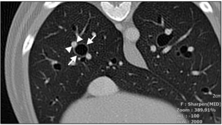 Fig. 2. CT image of the thorax of a dog at the level of the middle section of the seventh rib showing the right middle bronchus in the long-axis orientation