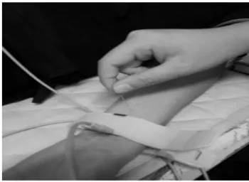 Fig.  1.  Instruments  for  measure  of  HRV(QECG-3). Fig.  2.  Acupuncture  at  PC6.