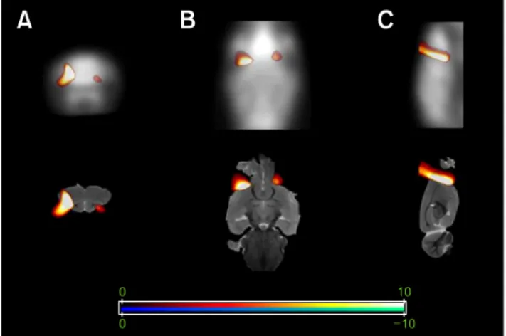 Fig. 4. Spatial parametric mapping (SPM) analysis was  performed in order to localize regions that showed a significant  difference in FDG uptake before and after HA