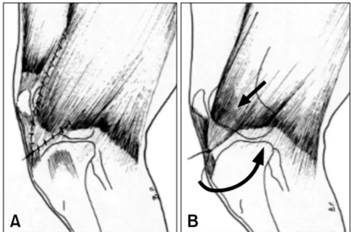 Fig. 1. (A) Preparation of a triangular flap taken from biceps  femoris muscle. (B) Transposition in a distal and medial  direction.