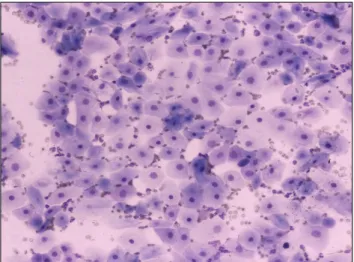 Fig. 2. Case 2. Gross appearance of a totally neoplastic testis 
