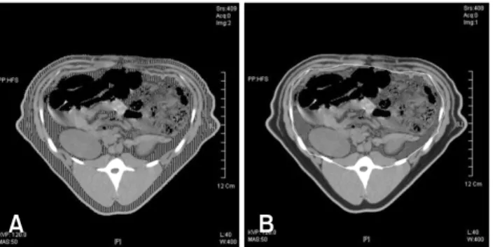 Fig. 1. Measurement of total (A, area of vertical stripes) and  visceral (B) abdominal adipose tissue on the cross-sectional  image at L3 level by thresholding using a computed tomography range of −147.47 to −83.46