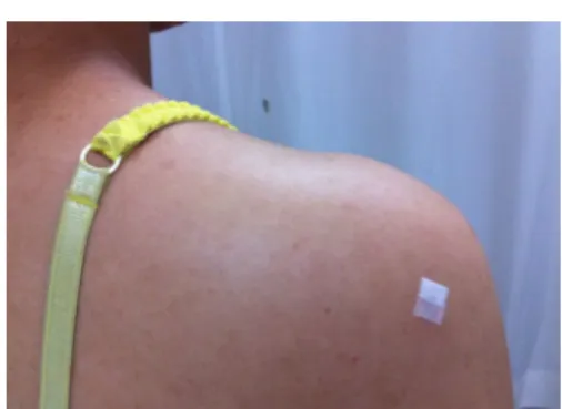 Fig. 2. Intradermal Acupuncture at Shoulder.
