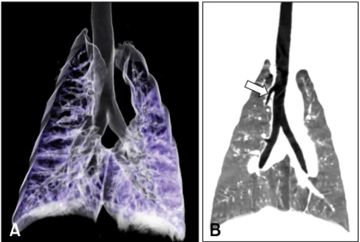 Fig. 1. (A) Three-dimensional external rendered image of the central airways in a normal micropig