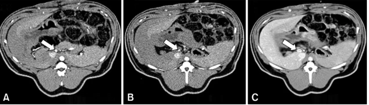 Fig. 2. Representative axial computed tomography image shows the size of the common hepatic artery (A) and proper hepatic artery (B) during the arterial phase and the portal vein (C) during the portal phase