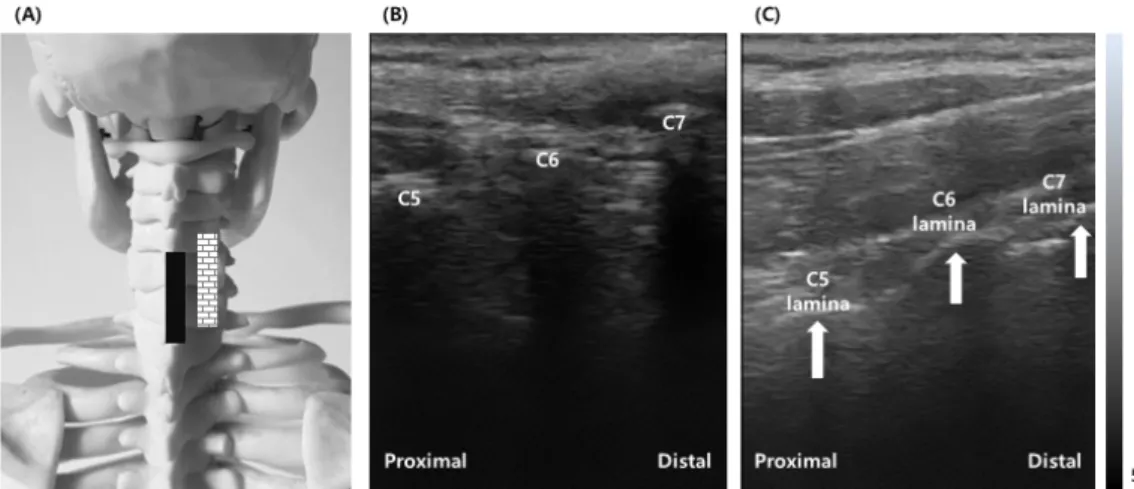 Fig.  1.  Longitudinal  scan  image  of  cervical  spine.  (A)  Postion  of  probe  (black  rectangle)  on  the  artificial  spine  model