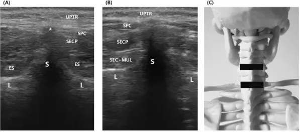 Fig.  2.  Subject’s  position  change.  (A)  Neutral  position.  (B)  Full  rotation  of  cervical  spine,  almost  80  degree