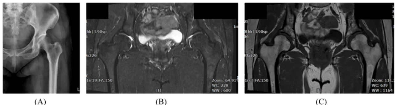 Fig.  1.  Radiology  examination  of  hip,  MRI  findings  (B,  C)  found  that  increased  signal  intensity  along  both  gluteus  tendon  and  adjacent  soft  tissue  layer  of  both  greater  trochanteric  area  with  small  fluid  collection  (A:  AP 