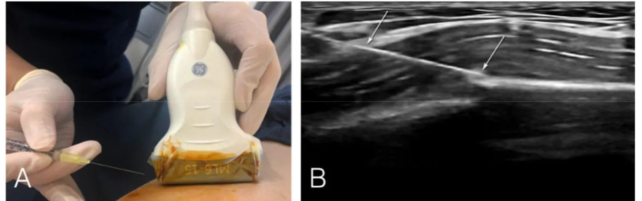 Fig. 2. Procedure of ultrasound-guided pharmacopuncture. (A) Image of searching for the proper site to apply pharmacopuncture  using ultrasound