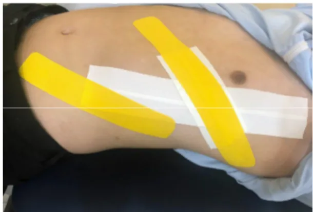 Fig. 4. Image of rib taping.