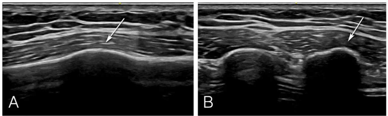 Fig. 6. Ultrasound image of callus formation of the fracture site after eight weeks. (A) Long-axis ultrasound image of lateral  aspect of the left sixth rib showing callus formation at the fracture site (arrow)