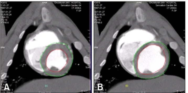 Fig. 2. Left ventriculogram by computerized tomography (A: 
