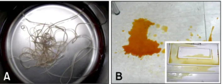 Fig. 5. Electrocardiograms (ECG) from Case No. 2. (A) The ECG recorded before the heartworm removal revealed normal sinus  rhythm with occasional ventricular premature complexes (the  4th, 5th, 7th 8th and 10th QRS complexes)