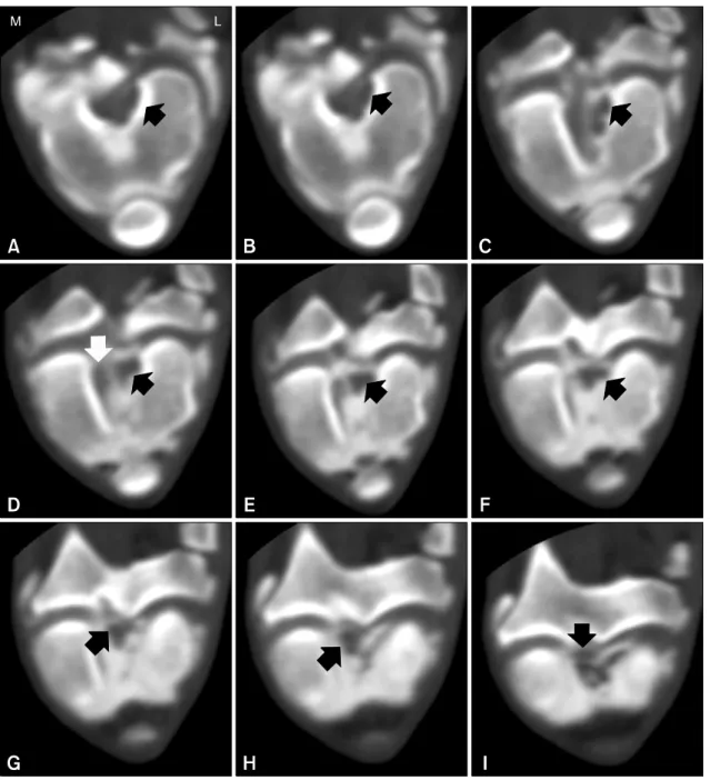 Fig. 3. Two-millimeter sequential transverse computed tomographic arthrography images were scanned parallel to the fibula, femoral  attachment (A), and tibial attachment (I)