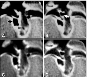 Fig. 4. Comparison of the pre-operative conventional view (A)  and tracing view (C) with the post-operative conventional view  (B) and tracing view (D)