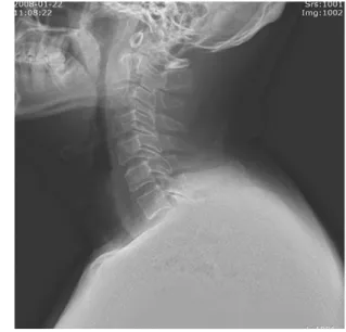 Fig. 2.  X-ray of Cervical spine. lateral view performed at 2008-01-22.
