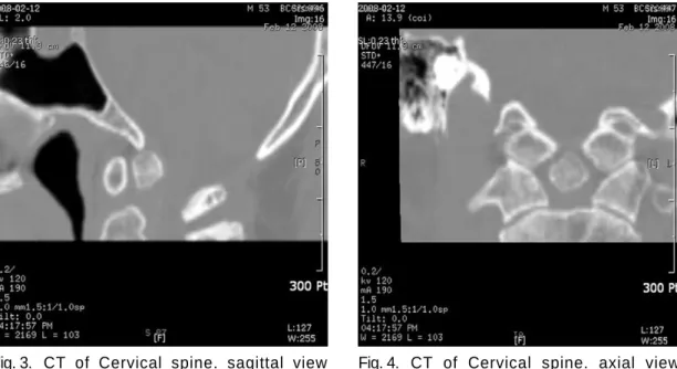 Fig. 3.  CT  of  Cervical spine. sagittal view performed at 2008-02-12. 