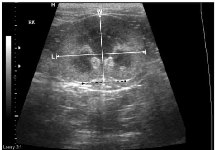 Fig. 3. Determination of renal length and height on the dorsal  plane. L: length, W: width